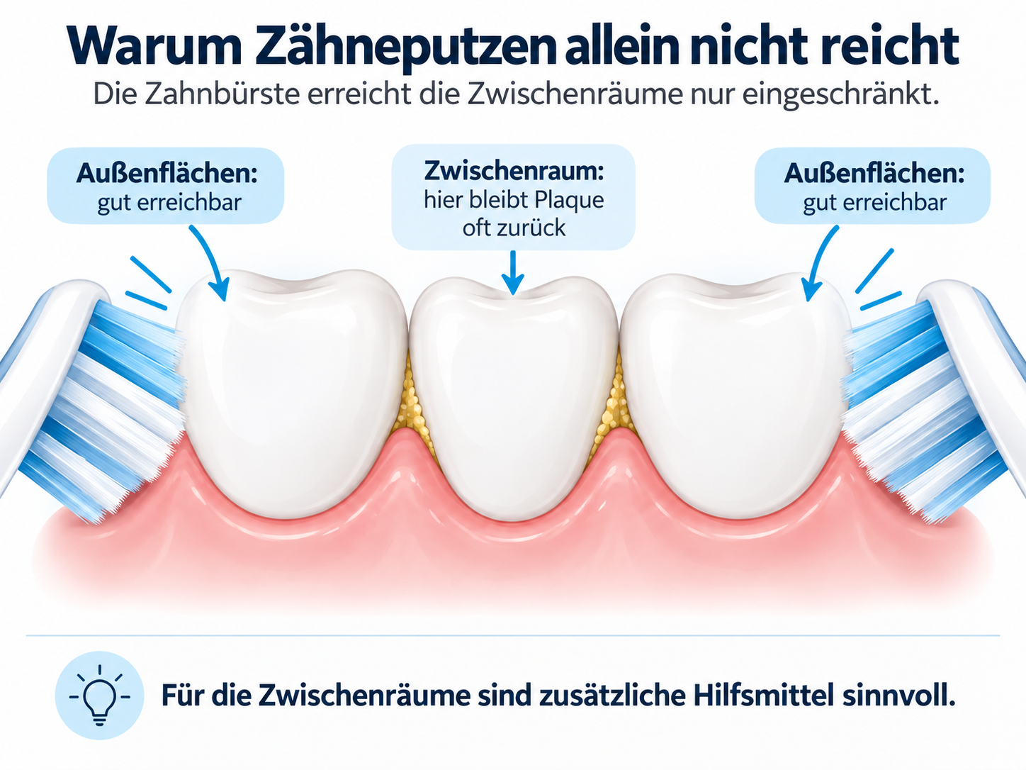 Illustration zeigt, warum die Zahnbürste Zahnzwischenräume nur eingeschränkt erreicht